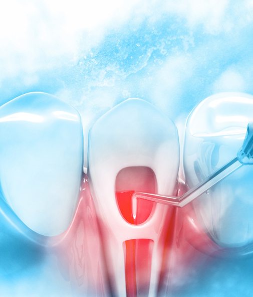 Illustration of performing root canal therapy on a single tooth