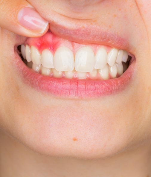 Smile with red soft tissue due to gum disease