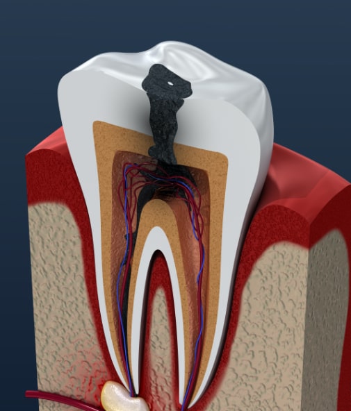 Animated tooth with infection before root canal therapy